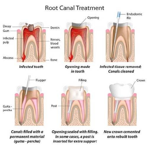 Root Canal Treatment (Rawatan Akar Gigi) Part I - Beeha Azman