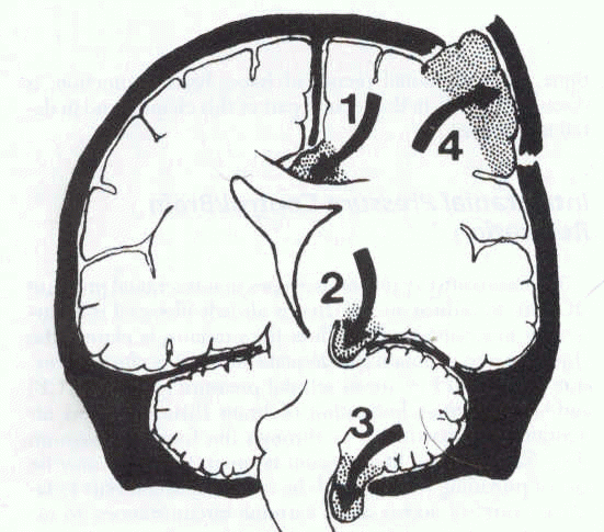 herniation of brain. Brain herniation Sites