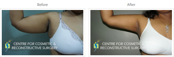 Liposuction in Mumbai