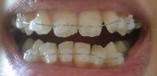 bracs, damon braces, damon clear braces, damon clear brackets, white braces, picture, one week