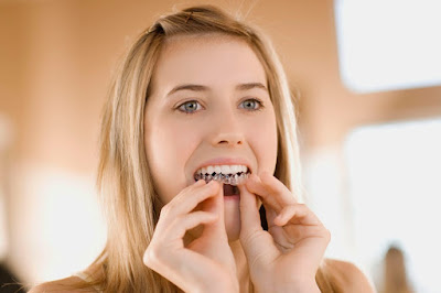 Niềng răng thẩm mỹ invisalign là gì ?