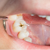 Cavities in Teeth: Causes, Symptoms, and Home Remedies