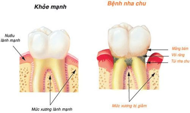 Bệnh nha chu rất phổ biến ở những người trong độ tuổi trung niên