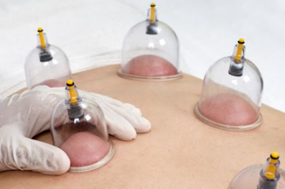 Cupping Therapy Course in india,cupping therapy institute in india,Hijama Course,cupping therapy course online,Cupping Course,cupping therapy course,Cupping Therapy Certificate Course