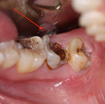 Bác sĩ cho biết răng bị sâu có nên nhổ không-1