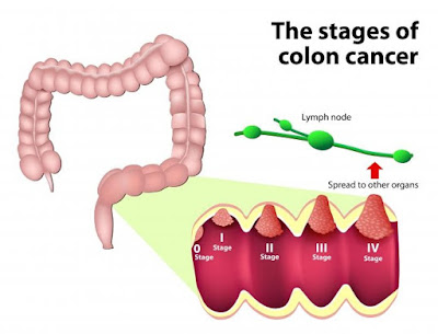 Colorectal Cancer: Causes, Symptoms and Treatments
