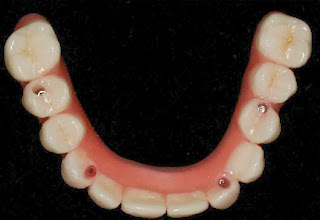 השתלות שיניים עם שתלים דנטאלים