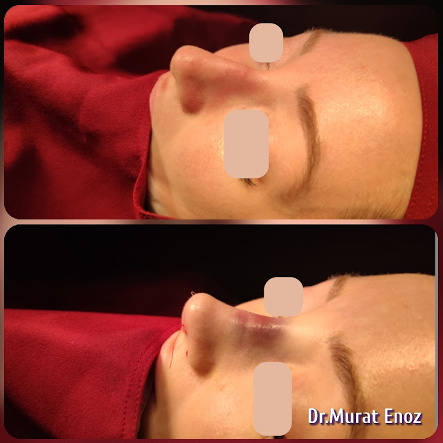 Natural Rhinoplasty, Natural Nose Job, Natural Nose Aesthetic Surgery, Natural Looking Nose Operation