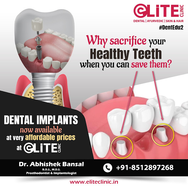 Dental Implant