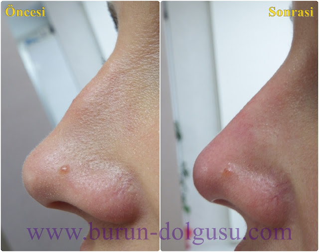 Non-surgical nose job - Non surgical nose job with filler - Non-surgical rhinoplasty - Nose tip filler augmentation - Non-surgical rhinoplasty - Nose filler injection - Non-surgical nose job in Istanbul - Non-surgical nose job istanbul - Nose filler injection Turkey