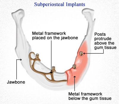 Superiosteal Implants