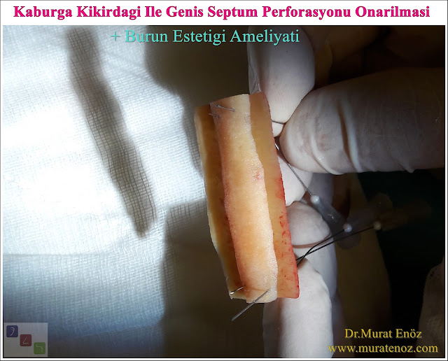 Nazal septum perforasyonu - Septum perforasyonu ameliyatı olanlar - Septum perforasyonu olanlar - Septum perforasyonu ameliyatı yapan doktorlar - Burunda delik oluşumu - Burun duvarında delik - Burun kıkırdak delinmesi tedavisi - Septum perforasyonu ameliyatı olanlar - Septum perforasyonu olanlar - Septal perforasyon tamiri - Septal buton uygulaması - Nazal septum perforasyonu tedavisi - Nazal septum perforasyonu nedenleri - Nazal septum perforasyonu belirtileri - Septum perforasyonun cerrahi onarımı - Burun delinmesinin nedenleri - Nazal septum perforasyonu tanısı - Erkek burun estetiği - Burun estetiği ameliyatı - Definition of Nasal Septal Perforation - Causes of Perforated Nasal Septum - Symptoms of Nasal Septal Perforation - Diagnosis of Nasal Septal Perforation - Surgical Treatment For Nasal Septal Perforation - Nasal Septal Perforation Repair - Surgical Repair of Nasal Septal Perforation