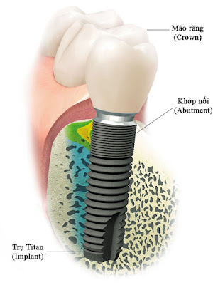 Phục hồi răng hư tổn nhờ cấy ghép Implant