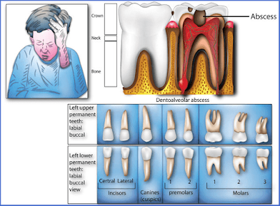 Toothache