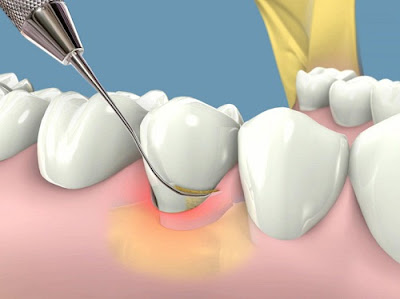 Cạo vôi răng giúp làm sạch vôi răng và mảng bám