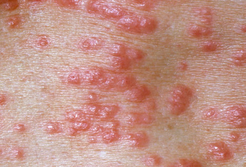  Wart Pictures on Healthy Life  Scabies