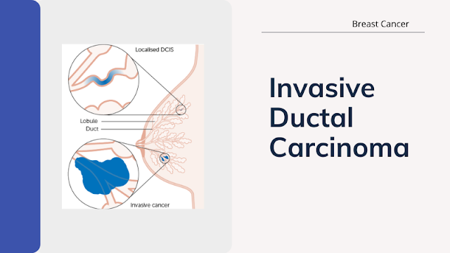 Invasive Ductal Carcinoma
