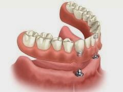 Dental Implants Cost