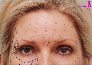 Who is a Good Candidate for Frontalis Botox