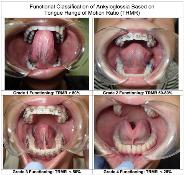 Ferrés-Amat Fonksiyonel Dil Bağı Sınıflandırılması - Maksimum insisiv dişler arası ağız açıklığı (maximal interincisal mouthopening / MIO) - Maksimum insisiv dişler arası ağız açıklığı (maximal interincisal mouthopening / MIO) - Tongue range of motion ratio - Dil aralığı hareket oranı - TRMR