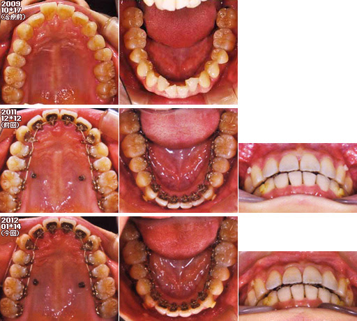 歯列矯正：定期検診その18
