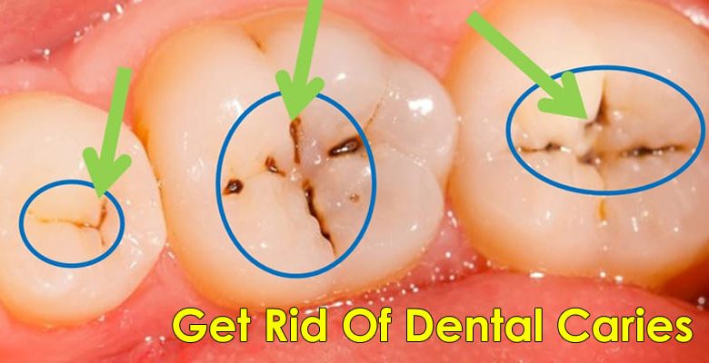 How-Do-I-Get-Rid-Of-Dental-Caries-At-Home