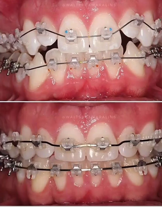 Fixed Braces Before and after