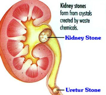 Estrogen therapy kidney stone