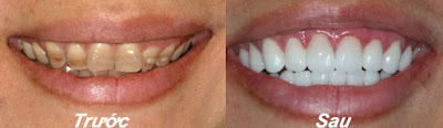 Nguyên nhân và cách khắc phục răng bị nhiễm tectracycline