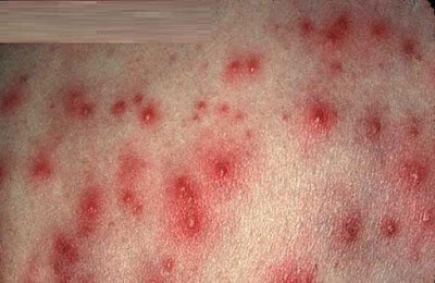 Cara Mengobati Herpes Atau Cacar Pada Kulit.