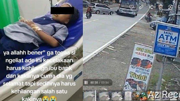 PILU Nasib MZ, Bocah Korban Kecelakaan, Ortu dan Kakak Meninggal, Kaki Diamputasi, Videonya Viral