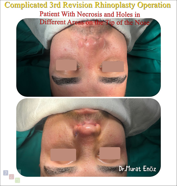 tertiary rhinoplasty, 3rd nose surgery, temporalis fascia technique, refined nasal aesthetics, expert revision cosmetic nose surgery, precision nasal enhancement, specialized rhinoplasty procedure.