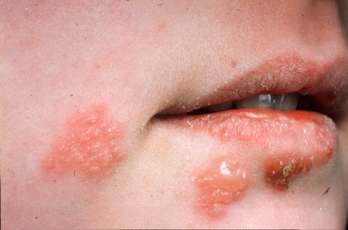 cara menyembuhkan herpes