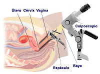 Colposcopia