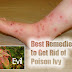 Best Remedies to Get Rid of Poison Ivy