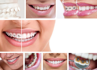 Niềng răng nhanh hiệu quả tại nha khoa uy tín