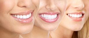 Chi phí tẩy trắng răng Brite Smile bao nhiêu?
