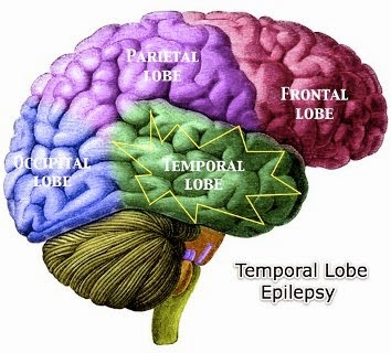 Temporal Lobe Epilepsy