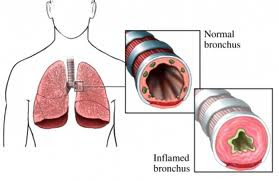 Berilliosis Beryllium Disease : Penyakit Paru Akibat Menghirup Debu 