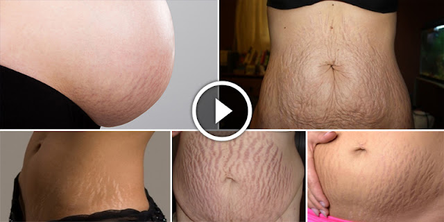 10 Proven Homemade Recipes To Remove Large Stretch Marks Very Fast