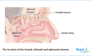 Gejala Sinusitis