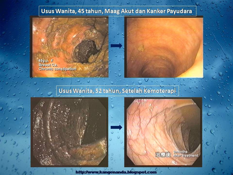 PUASA ALA DR HIROMI SHINYA - Apa Itu Kangen Water?