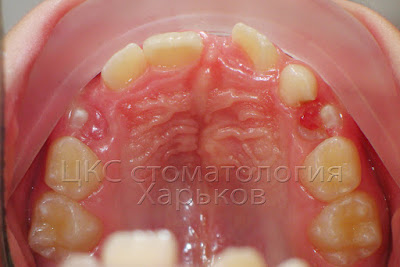 Зубной ряд пациента дистопия плюс сверхкомплектные зубы