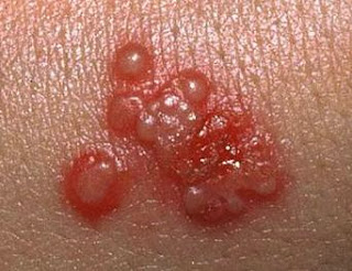 Metode Penularan Penyakit Herpes