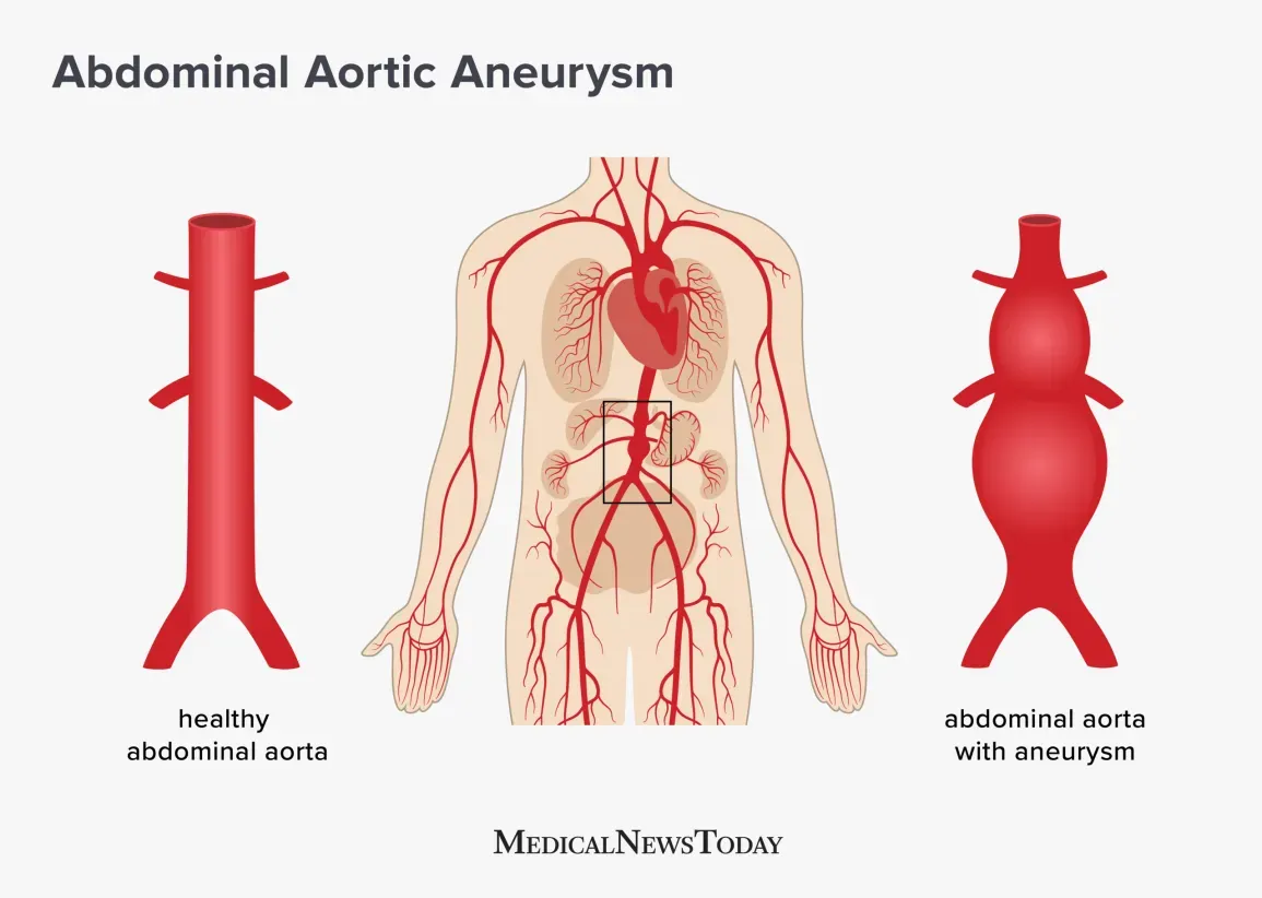 A picture portrays Abdominal Aortic Aneurysm