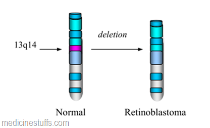 deletin-pada-kromosom-13q14