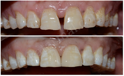 Treatment of Diastema Closure at Jamnagar dental