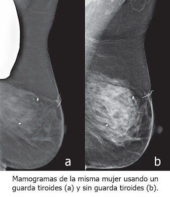 mamografia