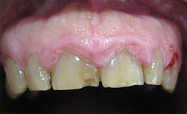 <Img src ="Agrandamiento-gingival-nifedipino-superior.jpg" width = "220" height "220" border = "0" alt = "Agrandamiento gingival moderado  inducido  por nifedipino">