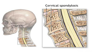 SPONDILOSIS SERVIKALIS